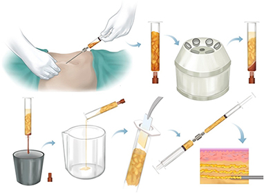 Face-Lipofilling-operational-Technique